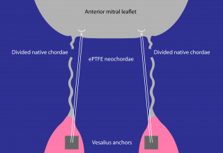 Schematic of the experimental setup. Vesalius anchors are deployed into opposing papillary muscles.