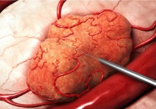 Alpha DaRT- Revolutionary Alpha Emitters Radiotherapy