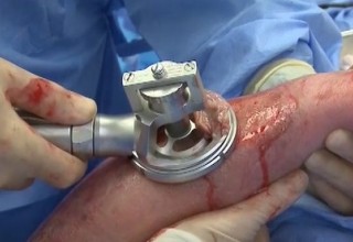 Amalgatome SD Surgical Device