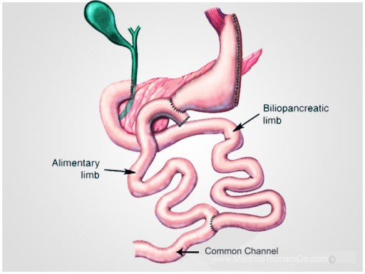 MTC's Network Surgeon Successfully Performs Bariatric Surgery on World's Heaviest Man in Guadalajara, Mexico