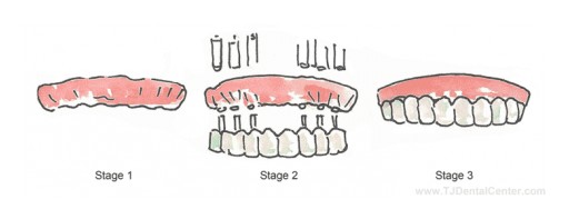 TJ Dental Center Announces Dental Implant Specials for Tijuana, Mexico
