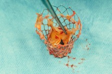 Global Transcatheter Mitral Valve Replacement Market Size, Status and Forecast 2019-2025