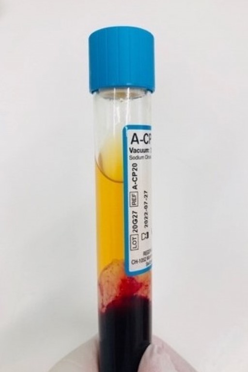 Passive Immune Prophylaxis preventing COVID-19 with 'Acellular-Convalescent Plasma' (A-CP): a new technology introduced by Regen Lab®