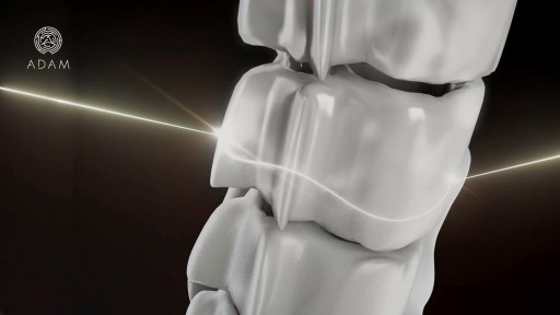 Graftless Bone Transplants Soon to Be Reality: ADAM Takes 3D Bones to Clinical Trials