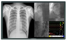 4K 8MP HD Cath Lab Display Monitor Screen