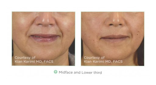 Non Surgical Aesthetics Are in High Demand, So Thread Lifts Are a New Way to Achieve Instant Skin Tightening