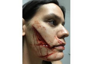 Glasgow Smile Wound
