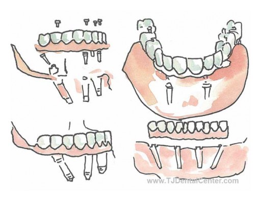 TJ Dental Center Announces Attractive All-on-4 Implant Packages in Tijuana, Mexico