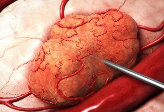 Alpha DaRT- Revolutionary Alpha Emitters Radiotherapy