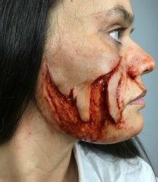 Dog Bite Wound