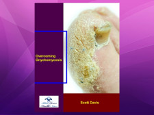 Overcoming Onychomycosis: Best Natural Toenail Fungus Cure