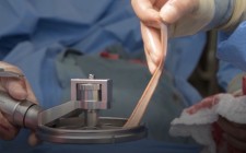 Amalgatome SD Surgical Device