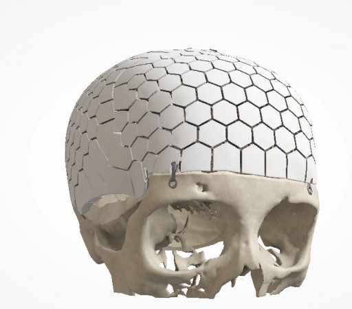 Major Cranial Reconstruction Using OssDsign Technology: Case Report Published in Journal of Neurosurgery