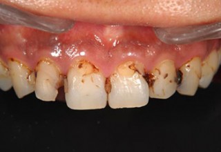 Porcelain Veneers Before