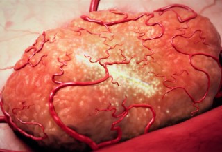 Highly Potent and Conformal Cancer Treatment