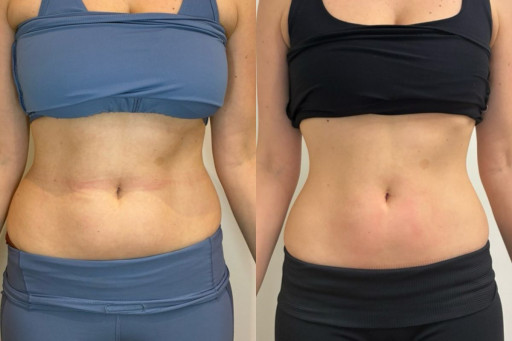 BODYWELLE Breaks Down How Morpheus8 Works to Tighten and Rejuvenate the Skin