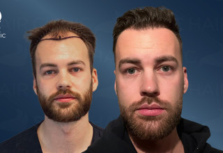 Before After from Smile Hair Clinic