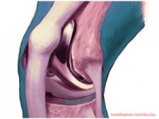 Knee Replacement in Tijuana