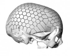 OSSDSIGN Cranial PSI
