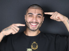 best hair transplant clinic in turkey hair center of turkey