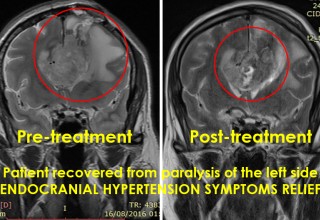 MR images of brain tumor pre- and post-microwave treatment