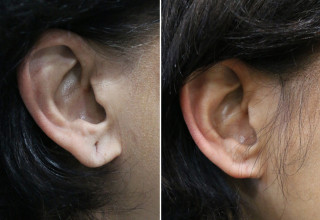 Earlobe repair is a common in-office procedure designed to correct stretched or torn piercings, often caused by heavy jewelry, trauma, or gauging.