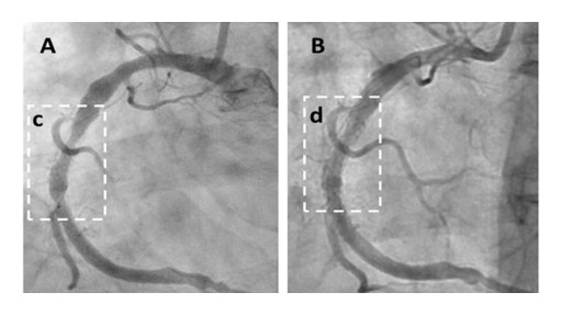 Australian Breakthrough by Cholrem: Cyclodextrin Therapy Reverses Heart Disease, Hailed as Greatest Advance Since Statins