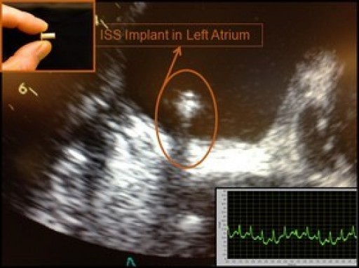 Intelligent Left-Heart Implantable Hemodynamic Monitor: Oral Presentation at the ESC Heart Failure Conference