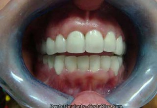 After Dental Implants