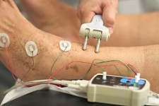 Performance of Nerve Conduction Study