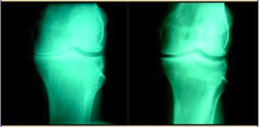 The Center for Regenerative Medicine Offers State-of-the-Art Non Surgical Solutions for Arthritic Conditions