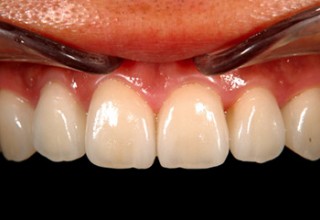 Porcelain Veneers After