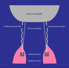 Schematic of the experimental setup. Vesalius anchors are deployed into opposing papillary muscles.